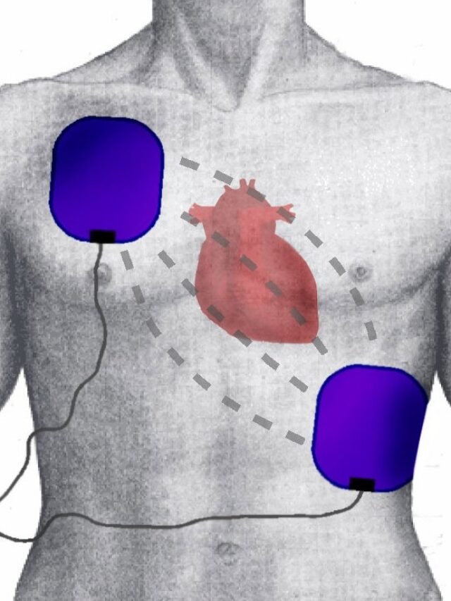 Defibrillation_Electrode_Position